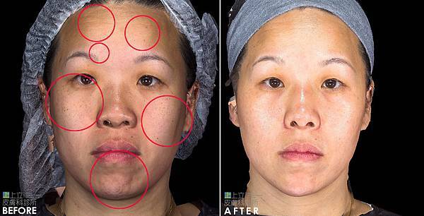 PicoSure蜂巢皮秒除皺雷射 除皺雷射 蜂巢皮秒機械光755雷射 淨膚雷射蜂巢瞬效透鏡 蜂巢皮秒機械光雷射PicoSure皮秒雷射雀斑曬斑 細紋眼下細紋毛孔粗大飛梭雷射縮毛孔淨膚雷射皮秒雷射價格皮秒雷射價錢皮秒雷射凹洞皮秒雷射除斑皮秒雷射刺青12.jpg PicoSure蜂巢皮秒除皺雷射 除皺雷射 蜂巢皮秒機械光755雷射 淨膚雷射蜂巢瞬效透鏡 蜂巢皮秒機械光雷射PicoSure皮秒雷射雀斑曬斑 細紋眼下細紋毛孔粗大飛梭雷射縮毛孔淨膚雷射皮秒雷射價格皮秒雷射價錢皮秒雷射凹洞皮秒雷射除斑皮秒雷射刺青12.jpg