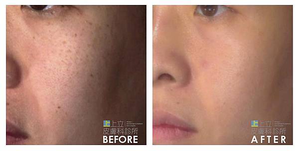 PicoSure蜂巢皮秒除皺雷射 除皺雷射 蜂巢皮秒機械光755雷射 淨膚雷射蜂巢瞬效透鏡 蜂巢皮秒機械光雷射PicoSure皮秒雷射雀斑曬斑 細紋眼下細紋毛孔粗大飛梭雷射縮毛孔淨膚雷射皮秒雷射價格皮秒雷射價錢皮秒雷射凹洞皮秒雷射除斑皮秒雷射刺青13.jpg PicoSure蜂巢皮秒除皺雷射 除皺雷射 蜂巢皮秒機械光755雷射 淨膚雷射蜂巢瞬效透鏡 蜂巢皮秒機械光雷射PicoSure皮秒雷射雀斑曬斑 細紋眼下細紋毛孔粗大飛梭雷射縮毛孔淨膚雷射皮秒雷射價格皮秒雷射價錢皮秒雷射凹洞皮秒雷射除斑皮秒雷射刺青13.jpg