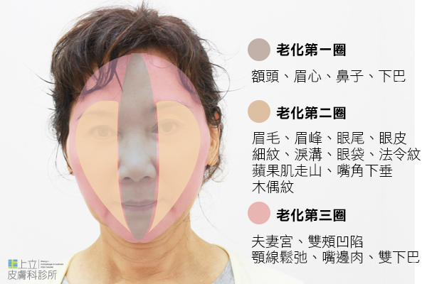 液態拉皮上立提新Ellansé 洢蓮絲聚己內酯少女針PolycaprolactonePCL膠原增生劑易麗適依戀詩3D聚左旋乳酸童顏針舒顏萃Sculptra晶亮瓷(微晶瓷)林上立上立皮膚科超音波拉皮超音波拉提01.jpg 液態拉皮上立提新Ellansé 洢蓮絲聚己內酯少女針PolycaprolactonePCL膠原增生劑易麗適依戀詩3D聚左旋乳酸童顏針舒顏萃Sculptra晶亮瓷(微晶瓷)林上立上立皮膚科超音波拉皮超音波拉提01.jpg