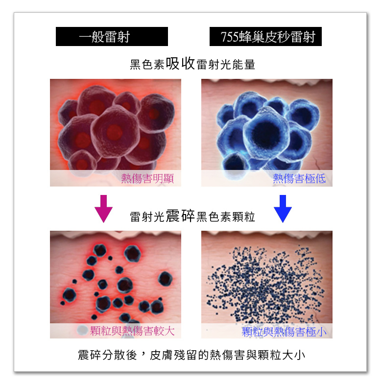 755蜂巢皮秒雷射Picosure皮秒機械光雷射范冰冰雷射飛梭雷射淨膚雷射5