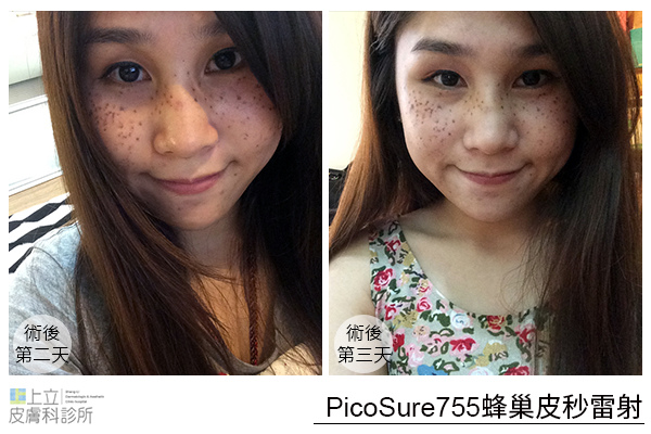 推薦 林上立醫師 上立皮膚科 755蜂巢皮秒雷射 755皮秒雷射 蜂巢皮秒雷射 皮秒除皺雷射 蜂巢瞬效透鏡 淡斑 除斑 凹疤 毛孔 細紋 (8) 推薦 林上立醫師 上立皮膚科 755蜂巢皮秒雷射 755皮秒雷射 蜂巢皮秒雷射 皮秒除皺雷射 蜂巢瞬效透鏡 淡斑 除斑 凹疤 毛孔 細紋 (8)