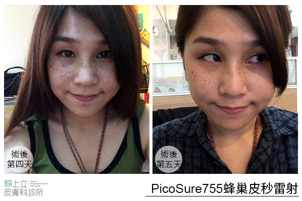 推薦 林上立醫師 上立皮膚科 755蜂巢皮秒雷射 755皮秒雷射 蜂巢皮秒雷射 皮秒除皺雷射 蜂巢瞬效透鏡 淡斑 除斑 凹疤 毛孔 細紋 (9) 推薦 林上立醫師 上立皮膚科 755蜂巢皮秒雷射 755皮秒雷射 蜂巢皮秒雷射 皮秒除皺雷射 蜂巢瞬效透鏡 淡斑 除斑 凹疤 毛孔 細紋 (9)