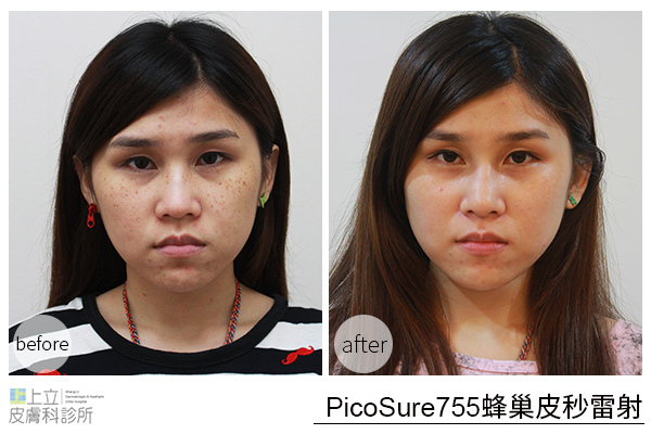 推薦 林上立醫師 上立皮膚科 755蜂巢皮秒雷射 755皮秒雷射 蜂巢皮秒雷射 皮秒除皺雷射 蜂巢瞬效透鏡 淡斑 除斑 凹疤 毛孔 細紋 (14) 推薦 林上立醫師 上立皮膚科 755蜂巢皮秒雷射 755皮秒雷射 蜂巢皮秒雷射 皮秒除皺雷射 蜂巢瞬效透鏡 淡斑 除斑 凹疤 毛孔 細紋 (14)