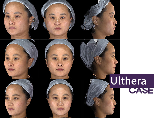 林上立 推薦 液態拉皮 推薦 極線音波拉提 推薦 極限音波拉皮 推薦 筋膜拉皮 推薦 超音波拉皮 推薦Ulthera超音波拉皮極線音波拉提筋膜拉皮超音波拉皮價格推薦02 林上立 推薦 液態拉皮 推薦 極線音波拉提 推薦 極限音波拉皮 推薦 筋膜拉皮 推薦 超音波拉皮 推薦Ulthera超音波拉皮極線音波拉提筋膜拉皮超音波拉皮價格推薦02