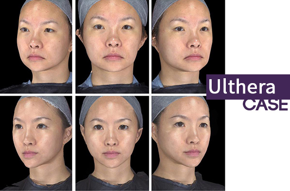 林上立 推薦 液態拉皮 推薦 極線音波拉提 推薦 極限音波拉皮 推薦 筋膜拉皮 推薦 超音波拉皮 推薦Ulthera超音波拉皮極線音波拉提筋膜拉皮超音波拉皮價格推薦03 林上立 推薦 液態拉皮 推薦 極線音波拉提 推薦 極限音波拉皮 推薦 筋膜拉皮 推薦 超音波拉皮 推薦Ulthera超音波拉皮極線音波拉提筋膜拉皮超音波拉皮價格推薦03