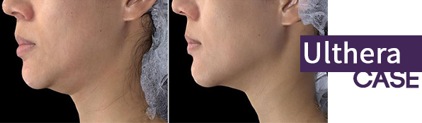 林上立 推薦 液態拉皮 推薦 極線音波拉提 推薦 極限音波拉皮 推薦 筋膜拉皮 推薦 超音波拉皮 推薦Ulthera超音波拉皮極線音波拉提筋膜拉皮超音波拉皮價格推薦05 林上立 推薦 液態拉皮 推薦 極線音波拉提 推薦 極限音波拉皮 推薦 筋膜拉皮 推薦 超音波拉皮 推薦Ulthera超音波拉皮極線音波拉提筋膜拉皮超音波拉皮價格推薦05