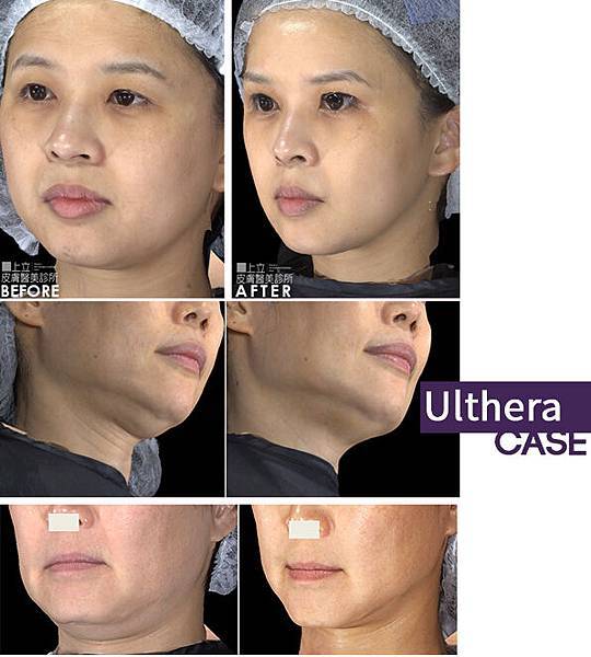 林上立 推薦 液態拉皮 推薦 極線音波拉提 推薦 極限音波拉皮 推薦 筋膜拉皮 推薦 超音波拉皮 推薦Ulthera超音波拉皮極線音波拉提筋膜拉皮超音波拉皮價格推薦04 林上立 推薦 液態拉皮 推薦 極線音波拉提 推薦 極限音波拉皮 推薦 筋膜拉皮 推薦 超音波拉皮 推薦Ulthera超音波拉皮極線音波拉提筋膜拉皮超音波拉皮價格推薦04