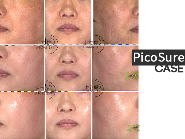 PicoSure蜂巢皮秒除皺雷射 除皺雷射 蜂巢皮秒機械光755雷射 淨膚雷射蜂巢瞬效透鏡 蜂巢皮秒機械光雷射PicoSure皮秒雷射雀斑曬斑 細紋眼下細紋毛孔粗大飛梭雷射縮毛孔淨膚雷射皮秒雷射價格皮秒雷射價錢皮秒雷射凹洞皮秒雷射除斑皮秒雷射刺青02.jpg PicoSure蜂巢皮秒除皺雷射 除皺雷射 蜂巢皮秒機械光755雷射 淨膚雷射蜂巢瞬效透鏡 蜂巢皮秒機械光雷射PicoSure皮秒雷射雀斑曬斑 細紋眼下細紋毛孔粗大飛梭雷射縮毛孔淨膚雷射皮秒雷射價格皮秒雷射價錢皮秒雷射凹洞皮秒雷射除斑皮秒雷射刺青02.jpg