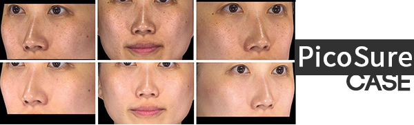 PicoSure蜂巢皮秒除皺雷射 除皺雷射 蜂巢皮秒機械光755雷射 淨膚雷射蜂巢瞬效透鏡 蜂巢皮秒機械光雷射PicoSure皮秒雷射雀斑曬斑 細紋眼下細紋毛孔粗大飛梭雷射縮毛孔淨膚雷射皮秒雷射價格皮秒雷射價錢皮秒雷射凹洞皮秒雷射除斑皮秒雷射刺青03.jpg PicoSure蜂巢皮秒除皺雷射 除皺雷射 蜂巢皮秒機械光755雷射 淨膚雷射蜂巢瞬效透鏡 蜂巢皮秒機械光雷射PicoSure皮秒雷射雀斑曬斑 細紋眼下細紋毛孔粗大飛梭雷射縮毛孔淨膚雷射皮秒雷射價格皮秒雷射價錢皮秒雷射凹洞皮秒雷射除斑皮秒雷射刺青03.jpg