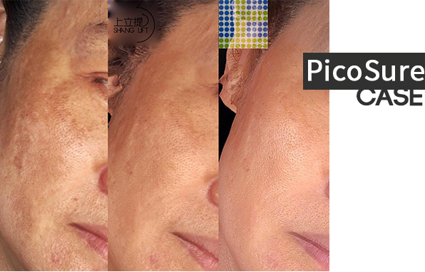 PicoSure蜂巢皮秒除皺雷射 除皺雷射 蜂巢皮秒機械光755雷射 淨膚雷射蜂巢瞬效透鏡 蜂巢皮秒機械光雷射PicoSure皮秒雷射雀斑曬斑 細紋眼下細紋毛孔粗大飛梭雷射縮毛孔淨膚雷射皮秒雷射價格皮秒雷射價錢皮秒雷射凹洞皮秒雷射除斑皮秒雷射刺青04.jpg PicoSure蜂巢皮秒除皺雷射 除皺雷射 蜂巢皮秒機械光755雷射 淨膚雷射蜂巢瞬效透鏡 蜂巢皮秒機械光雷射PicoSure皮秒雷射雀斑曬斑 細紋眼下細紋毛孔粗大飛梭雷射縮毛孔淨膚雷射皮秒雷射價格皮秒雷射價錢皮秒雷射凹洞皮秒雷射除斑皮秒雷射刺青04.jpg