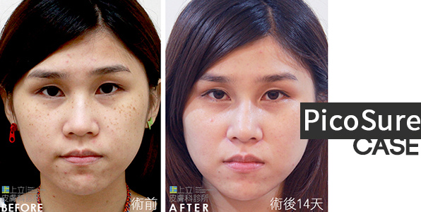 PicoSure蜂巢皮秒除皺雷射 除皺雷射 蜂巢皮秒機械光755雷射 淨膚雷射蜂巢瞬效透鏡 蜂巢皮秒機械光雷射PicoSure皮秒雷射雀斑曬斑 細紋眼下細紋毛孔粗大飛梭雷射縮毛孔淨膚雷射皮秒雷射價格皮秒雷射價錢皮秒雷射凹洞皮秒雷射除斑皮秒雷射刺青05.jpg PicoSure蜂巢皮秒除皺雷射 除皺雷射 蜂巢皮秒機械光755雷射 淨膚雷射蜂巢瞬效透鏡 蜂巢皮秒機械光雷射PicoSure皮秒雷射雀斑曬斑 細紋眼下細紋毛孔粗大飛梭雷射縮毛孔淨膚雷射皮秒雷射價格皮秒雷射價錢皮秒雷射凹洞皮秒雷射除斑皮秒雷射刺青05.jpg