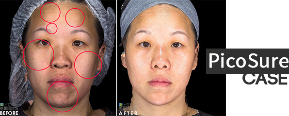 PicoSure蜂巢皮秒除皺雷射 除皺雷射 蜂巢皮秒機械光755雷射 淨膚雷射蜂巢瞬效透鏡 蜂巢皮秒機械光雷射PicoSure皮秒雷射雀斑曬斑 細紋眼下細紋毛孔粗大飛梭雷射縮毛孔淨膚雷射皮秒雷射價格皮秒雷射價錢皮秒雷射凹洞皮秒雷射除斑皮秒雷射刺青06.jpg PicoSure蜂巢皮秒除皺雷射 除皺雷射 蜂巢皮秒機械光755雷射 淨膚雷射蜂巢瞬效透鏡 蜂巢皮秒機械光雷射PicoSure皮秒雷射雀斑曬斑 細紋眼下細紋毛孔粗大飛梭雷射縮毛孔淨膚雷射皮秒雷射價格皮秒雷射價錢皮秒雷射凹洞皮秒雷射除斑皮秒雷射刺青06.jpg