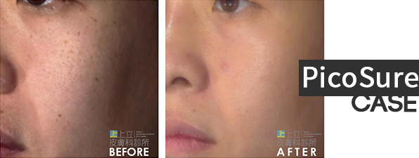 PicoSure蜂巢皮秒除皺雷射 除皺雷射 蜂巢皮秒機械光755雷射 淨膚雷射蜂巢瞬效透鏡 蜂巢皮秒機械光雷射PicoSure皮秒雷射雀斑曬斑 細紋眼下細紋毛孔粗大飛梭雷射縮毛孔淨膚雷射皮秒雷射價格皮秒雷射價錢皮秒雷射凹洞皮秒雷射除斑皮秒雷射刺青07.jpg PicoSure蜂巢皮秒除皺雷射 除皺雷射 蜂巢皮秒機械光755雷射 淨膚雷射蜂巢瞬效透鏡 蜂巢皮秒機械光雷射PicoSure皮秒雷射雀斑曬斑 細紋眼下細紋毛孔粗大飛梭雷射縮毛孔淨膚雷射皮秒雷射價格皮秒雷射價錢皮秒雷射凹洞皮秒雷射除斑皮秒雷射刺青07.jpg