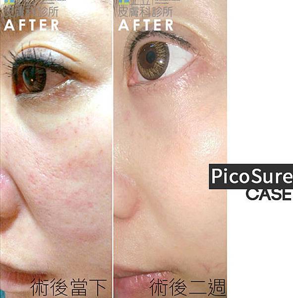 PicoSure蜂巢皮秒除皺雷射 除皺雷射 蜂巢皮秒機械光755雷射 淨膚雷射蜂巢瞬效透鏡 蜂巢皮秒機械光雷射PicoSure皮秒雷射雀斑曬斑 細紋眼下細紋毛孔粗大飛梭雷射縮毛孔淨膚雷射皮秒雷射價格皮秒雷射價錢皮秒雷射凹洞皮秒雷射除斑皮秒雷射刺青08.jpg PicoSure蜂巢皮秒除皺雷射 除皺雷射 蜂巢皮秒機械光755雷射 淨膚雷射蜂巢瞬效透鏡 蜂巢皮秒機械光雷射PicoSure皮秒雷射雀斑曬斑 細紋眼下細紋毛孔粗大飛梭雷射縮毛孔淨膚雷射皮秒雷射價格皮秒雷射價錢皮秒雷射凹洞皮秒雷射除斑皮秒雷射刺青08.jpg