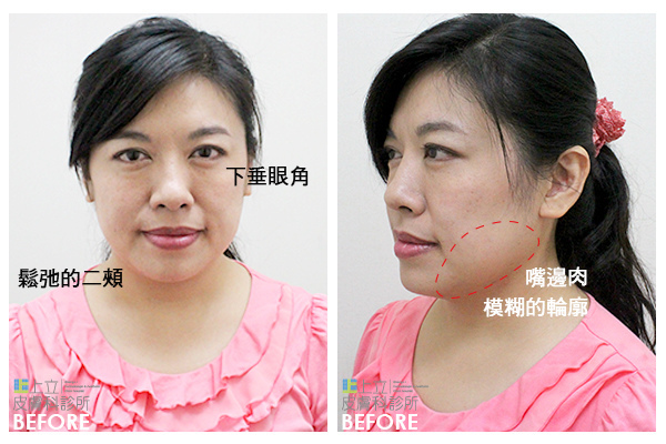 老人胖老人瘦少女計劃林上立醫生液態拉皮上立提 液態拉皮 推薦 3D聚左旋乳酸 舒顏萃 童顏針 3D聚左旋乳酸 價格 3D聚左旋乳酸 費用 Ellansé 洢蓮絲少女針PolycaprolactonePCL膠原增生劑易麗適依戀詩03.jpg 老人胖老人瘦少女計劃林上立醫生液態拉皮上立提 液態拉皮 推薦 3D聚左旋乳酸 舒顏萃 童顏針 3D聚左旋乳酸 價格 3D聚左旋乳酸 費用 Ellansé 洢蓮絲少女針PolycaprolactonePCL膠原增生劑易麗適依戀詩03.jpg