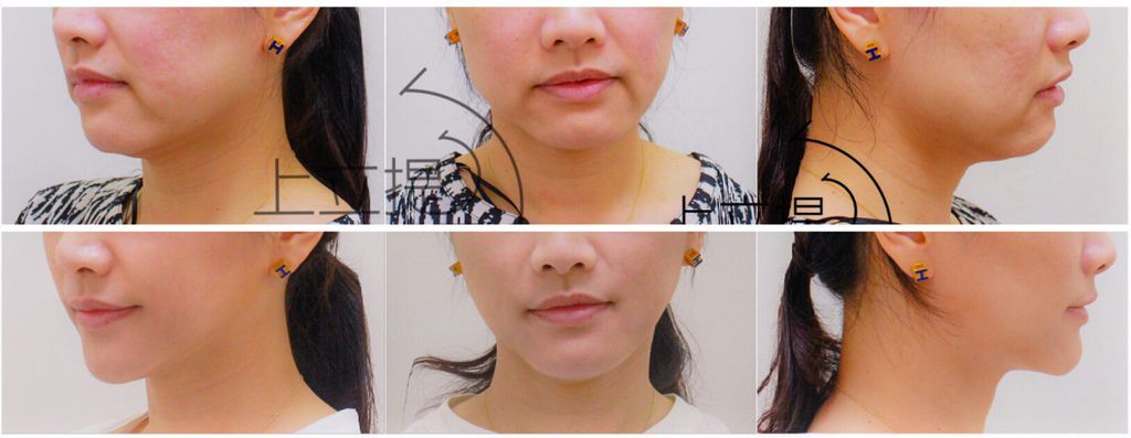 少女計劃林上立醫生液態拉皮上立提 液態拉皮 推薦 3D聚左旋乳酸 舒顏萃 童顏針 3D聚左旋乳酸 價格 3D聚左旋乳酸 費用 Ellansé 洢蓮絲少女針PolycaprolactonePCL膠原增生劑易麗適依戀詩02.jpg 少女計劃林上立醫生液態拉皮上立提 液態拉皮 推薦 3D聚左旋乳酸 舒顏萃 童顏針 3D聚左旋乳酸 價格 3D聚左旋乳酸 費用 Ellansé 洢蓮絲少女針PolycaprolactonePCL膠原增生劑易麗適依戀詩02.jpg