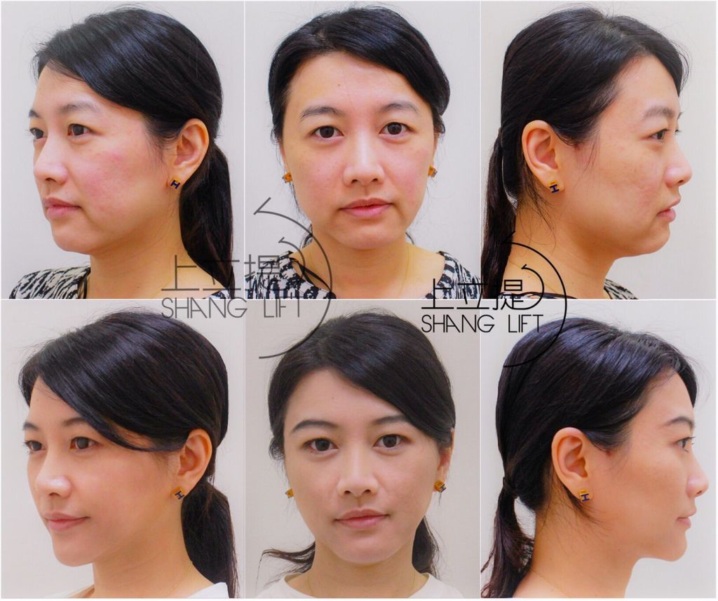 少女計劃林上立醫生液態拉皮上立提 液態拉皮 推薦 3D聚左旋乳酸 舒顏萃 童顏針 3D聚左旋乳酸 價格 3D聚左旋乳酸 費用 Ellansé 洢蓮絲少女針PolycaprolactonePCL膠原增生劑易麗適依戀詩03.jpg 少女計劃林上立醫生液態拉皮上立提 液態拉皮 推薦 3D聚左旋乳酸 舒顏萃 童顏針 3D聚左旋乳酸 價格 3D聚左旋乳酸 費用 Ellansé 洢蓮絲少女針PolycaprolactonePCL膠原增生劑易麗適依戀詩03.jpg