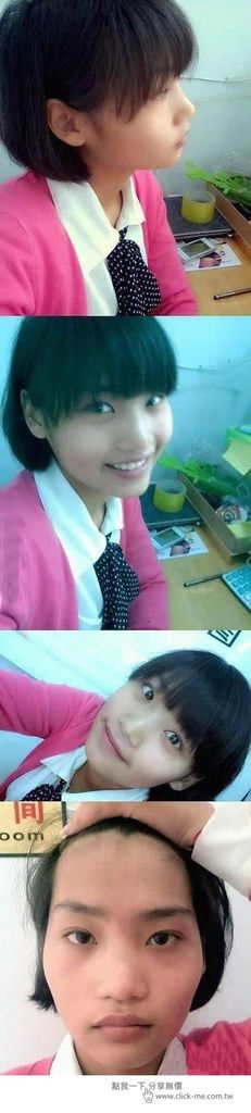 少女計劃林上立醫生液態拉皮上立提 液態拉皮 推薦 Ellansé 洢蓮絲少女針PolycaprolactonePCL膠原增生劑易麗適依戀詩額頭PicoSure蜂巢皮秒除皺雷射 除皺雷射 蜂巢皮秒機械光755雷射 淨膚雷射蜂巢瞬效透鏡 蜂巢皮秒機械光雷射PicoSure皮秒雷射雀斑曬斑 細紋眼下細紋毛孔粗大飛梭雷射縮毛孔淨膚雷射皮秒雷射價格皮秒雷射價錢皮秒雷射凹洞皮秒雷射除斑皮秒雷射刺青01.jpg 少女計劃林上立醫生液態拉皮上立提 液態拉皮 推薦 Ellansé 洢蓮絲少女針PolycaprolactonePCL膠原增生劑易麗適依戀詩額頭PicoSure蜂巢皮秒除皺雷射 除皺雷射 蜂巢皮秒機械光755雷射 淨膚雷射蜂巢瞬效透鏡 蜂巢皮秒機械光雷射PicoSure皮秒雷射雀斑曬斑 細紋眼下細紋毛孔粗大飛梭雷射縮毛孔淨膚雷射皮秒雷射價格皮秒雷射價錢皮秒雷射凹洞皮秒雷射除斑皮秒雷射刺青01.jpg