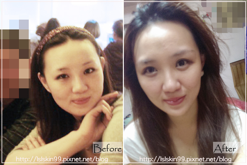 少女計劃林上立醫生液態拉皮上立提 液態拉皮 推薦 Ellansé 洢蓮絲少女針PolycaprolactonePCL膠原增生劑易麗適依戀詩額頭PicoSure蜂巢皮秒除皺雷射 除皺雷射 蜂巢皮秒機械光755雷射 淨膚雷射蜂巢瞬效透鏡 蜂巢皮秒機械光雷射PicoSure皮秒雷射雀斑曬斑 細紋眼下細紋毛孔粗大飛梭雷射縮毛孔淨膚雷射皮秒雷射價格皮秒雷射價錢皮秒雷射凹洞皮秒雷射除斑皮秒雷射刺青10.jpg 少女計劃林上立醫生液態拉皮上立提 液態拉皮 推薦 Ellansé 洢蓮絲少女針PolycaprolactonePCL膠原增生劑易麗適依戀詩額頭PicoSure蜂巢皮秒除皺雷射 除皺雷射 蜂巢皮秒機械光755雷射 淨膚雷射蜂巢瞬效透鏡 蜂巢皮秒機械光雷射PicoSure皮秒雷射雀斑曬斑 細紋眼下細紋毛孔粗大飛梭雷射縮毛孔淨膚雷射皮秒雷射價格皮秒雷射價錢皮秒雷射凹洞皮秒雷射除斑皮秒雷射刺青10.jpg