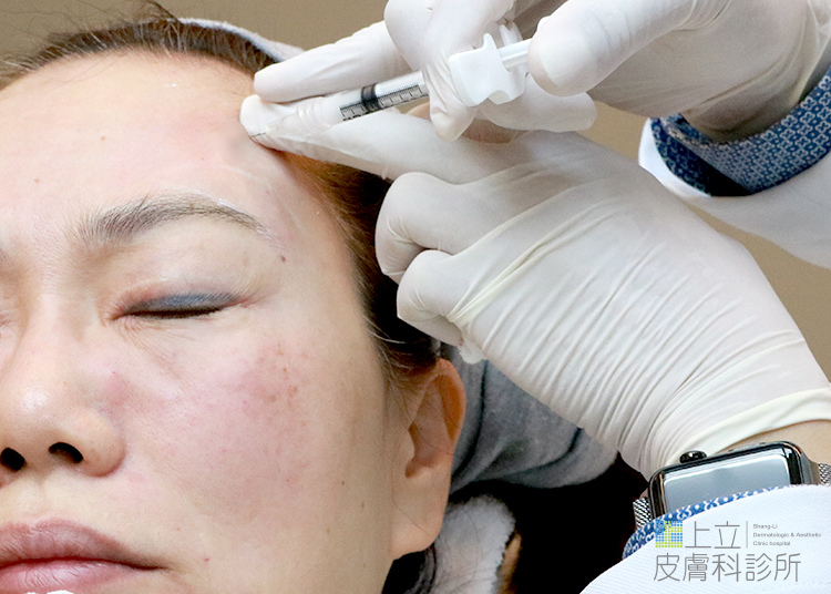 少女計劃林上立醫生液態拉皮上立提 液態拉皮 推薦 Ellansé 洢蓮絲少女針PolycaprolactonePCL膠原增生劑易麗適依戀詩額頭PicoSure蜂巢皮秒除皺雷射 除皺雷射 蜂巢皮秒機械光755雷射 淨膚雷射蜂巢瞬效透鏡 蜂巢皮秒機械光雷射PicoSure皮秒雷射雀斑曬斑 細紋眼下細紋毛孔粗大飛梭雷射縮毛孔淨膚雷射皮秒雷射價格皮秒雷射價錢皮秒雷射凹洞皮秒雷射除斑皮秒雷射刺青09.jpg 少女計劃林上立醫生液態拉皮上立提 液態拉皮 推薦 Ellansé 洢蓮絲少女針PolycaprolactonePCL膠原增生劑易麗適依戀詩額頭PicoSure蜂巢皮秒除皺雷射 除皺雷射 蜂巢皮秒機械光755雷射 淨膚雷射蜂巢瞬效透鏡 蜂巢皮秒機械光雷射PicoSure皮秒雷射雀斑曬斑 細紋眼下細紋毛孔粗大飛梭雷射縮毛孔淨膚雷射皮秒雷射價格皮秒雷射價錢皮秒雷射凹洞皮秒雷射除斑皮秒雷射刺青09.jpg