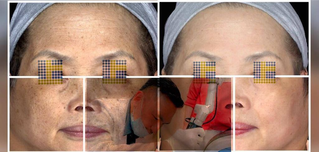 少女計劃林上立醫生液態拉皮上立提 液態拉皮 推薦 Ellansé 洢蓮絲少女針PolycaprolactonePCL膠原增生劑易麗適依戀詩額頭PicoSure蜂巢皮秒除皺雷射 除皺雷射 蜂巢皮秒機械光755雷射 淨膚雷射蜂巢瞬效透鏡 蜂巢皮秒機械光雷射PicoSure皮秒雷射雀斑曬斑 細紋眼下細紋毛孔粗大飛梭雷射縮毛孔淨膚雷射皮秒雷射價格皮秒雷射價錢皮秒雷射凹洞皮秒雷射除斑皮秒雷射刺青11.jpg 少女計劃林上立醫生液態拉皮上立提 液態拉皮 推薦 Ellansé 洢蓮絲少女針PolycaprolactonePCL膠原增生劑易麗適依戀詩額頭PicoSure蜂巢皮秒除皺雷射 除皺雷射 蜂巢皮秒機械光755雷射 淨膚雷射蜂巢瞬效透鏡 蜂巢皮秒機械光雷射PicoSure皮秒雷射雀斑曬斑 細紋眼下細紋毛孔粗大飛梭雷射縮毛孔淨膚雷射皮秒雷射價格皮秒雷射價錢皮秒雷射凹洞皮秒雷射除斑皮秒雷射刺青11.jpg