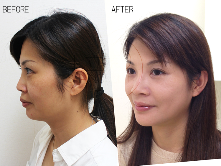 液態拉皮聚己內脂少女針依戀詩伊蓮絲Ellanse3d聚左旋乳酸塑然雅舒顏萃Sculptra童顏針拉皮手術超音波拉提1.png 液態拉皮聚己內脂少女針依戀詩伊蓮絲Ellanse3d聚左旋乳酸塑然雅舒顏萃Sculptra童顏針拉皮手術超音波拉提1.png