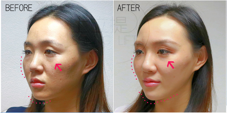 液態拉皮聚己內脂少女針依戀詩伊蓮絲Ellanse3d聚左旋乳酸塑然雅舒顏萃Sculptra童顏針拉皮手術超音波拉提2.jpg 液態拉皮聚己內脂少女針依戀詩伊蓮絲Ellanse3d聚左旋乳酸塑然雅舒顏萃Sculptra童顏針拉皮手術超音波拉提2.jpg