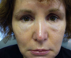 上立皮膚科林上立上立皮膚科 費用 林上立 價格 林上立 評價 林上立推薦微整型風險注意事項眉間額頭鼻子法令紋淚溝下巴埋線拉提肉毒桿菌瘦小臉肉毒桿菌除皺全臉拉提緊實02.png 上立皮膚科林上立上立皮膚科 費用 林上立 價格 林上立 評價 林上立推薦微整型風險注意事項眉間額頭鼻子法令紋淚溝下巴埋線拉提肉毒桿菌瘦小臉肉毒桿菌除皺全臉拉提緊實02.png