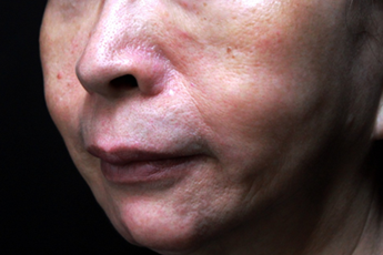 上立皮膚科林上立上立皮膚科 費用 林上立 價格 林上立 評價 林上立推薦微整型風險注意事項眉間額頭鼻子法令紋淚溝下巴埋線拉提肉毒桿菌瘦小臉肉毒桿菌除皺全臉拉提緊實03.png 上立皮膚科林上立上立皮膚科 費用 林上立 價格 林上立 評價 林上立推薦微整型風險注意事項眉間額頭鼻子法令紋淚溝下巴埋線拉提肉毒桿菌瘦小臉肉毒桿菌除皺全臉拉提緊實03.png