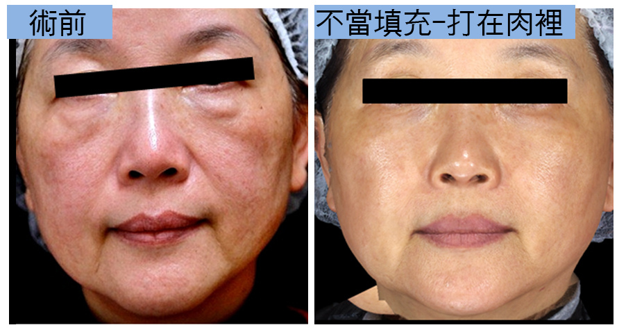 上立皮膚科林上立上立皮膚科 費用 林上立 價格 林上立 評價 林上立推薦微整型風險注意事項眉間額頭鼻子法令紋淚溝下巴埋線拉提肉毒桿菌瘦小臉肉毒桿菌除皺全臉拉提緊實04.jpg 上立皮膚科林上立上立皮膚科 費用 林上立 價格 林上立 評價 林上立推薦微整型風險注意事項眉間額頭鼻子法令紋淚溝下巴埋線拉提肉毒桿菌瘦小臉肉毒桿菌除皺全臉拉提緊實04.jpg