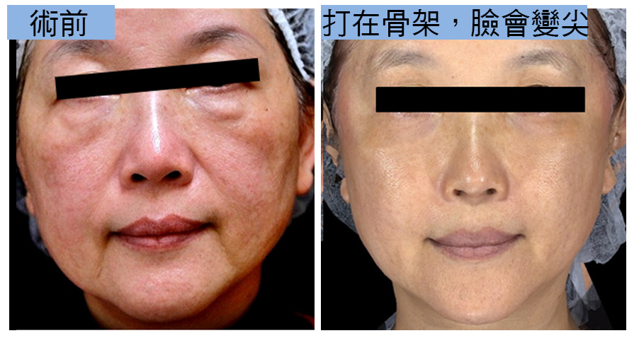 上立皮膚科林上立上立皮膚科 費用 林上立 價格 林上立 評價 林上立推薦微整型風險注意事項眉間額頭鼻子法令紋淚溝下巴埋線拉提肉毒桿菌瘦小臉肉毒桿菌除皺全臉拉提緊實05.jpg 上立皮膚科林上立上立皮膚科 費用 林上立 價格 林上立 評價 林上立推薦微整型風險注意事項眉間額頭鼻子法令紋淚溝下巴埋線拉提肉毒桿菌瘦小臉肉毒桿菌除皺全臉拉提緊實05.jpg