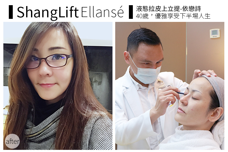少女計劃林上立醫生液態拉皮上立提 液態拉皮 推薦 Ellansé 洢蓮絲少女針PolycaprolactonePCL膠原增生劑易麗適依戀詩拉皮緊實鬆垮下垂膠原蛋白增生.jpg 少女計劃林上立醫生液態拉皮上立提 液態拉皮 推薦 Ellansé 洢蓮絲少女針PolycaprolactonePCL膠原增生劑易麗適依戀詩拉皮緊實鬆垮下垂膠原蛋白增生.jpg