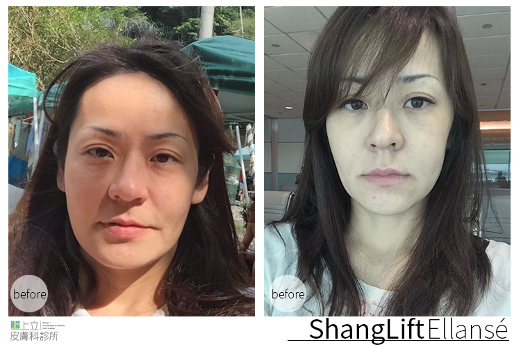 少女計劃林上立醫生液態拉皮上立提 液態拉皮 推薦 Ellansé 洢蓮絲少女針PolycaprolactonePCL膠原增生劑易麗適依戀詩拉皮緊實鬆垮下垂膠原蛋白增生01.jpg 少女計劃林上立醫生液態拉皮上立提 液態拉皮 推薦 Ellansé 洢蓮絲少女針PolycaprolactonePCL膠原增生劑易麗適依戀詩拉皮緊實鬆垮下垂膠原蛋白增生01.jpg