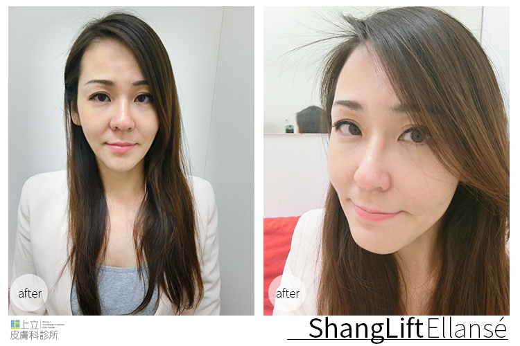 少女計劃林上立醫生液態拉皮上立提 液態拉皮 推薦 Ellansé 洢蓮絲少女針PolycaprolactonePCL膠原增生劑易麗適依戀詩拉皮緊實鬆垮下垂膠原蛋白增生10.jpg 少女計劃林上立醫生液態拉皮上立提 液態拉皮 推薦 Ellansé 洢蓮絲少女針PolycaprolactonePCL膠原增生劑易麗適依戀詩拉皮緊實鬆垮下垂膠原蛋白增生10.jpg