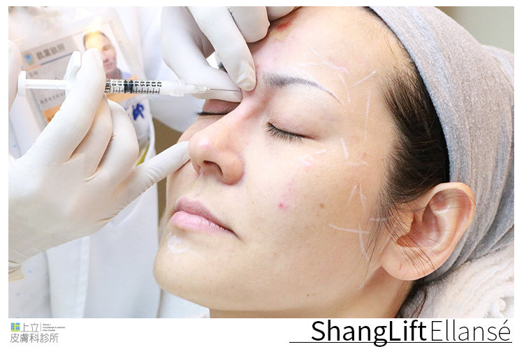 少女計劃林上立醫生液態拉皮上立提 液態拉皮 推薦 Ellansé 洢蓮絲少女針PolycaprolactonePCL膠原增生劑易麗適依戀詩拉皮緊實鬆垮下垂膠原蛋白增生05 少女計劃林上立醫生液態拉皮上立提 液態拉皮 推薦 Ellansé 洢蓮絲少女針PolycaprolactonePCL膠原增生劑易麗適依戀詩拉皮緊實鬆垮下垂膠原蛋白增生05