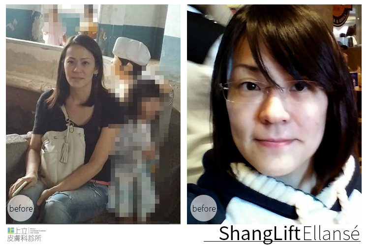 少女計劃林上立醫生液態拉皮上立提 液態拉皮 推薦 Ellansé 洢蓮絲少女針PolycaprolactonePCL膠原增生劑易麗適依戀詩拉皮緊實鬆垮下垂膠原蛋白增生11 少女計劃林上立醫生液態拉皮上立提 液態拉皮 推薦 Ellansé 洢蓮絲少女針PolycaprolactonePCL膠原增生劑易麗適依戀詩拉皮緊實鬆垮下垂膠原蛋白增生11