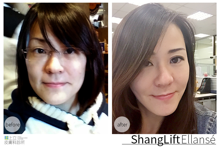 少女計劃林上立醫生液態拉皮上立提 液態拉皮 推薦 Ellansé 洢蓮絲少女針PolycaprolactonePCL膠原增生劑易麗適依戀詩拉皮緊實鬆垮下垂膠原蛋白增生11 少女計劃林上立醫生液態拉皮上立提 液態拉皮 推薦 Ellansé 洢蓮絲少女針PolycaprolactonePCL膠原增生劑易麗適依戀詩拉皮緊實鬆垮下垂膠原蛋白增生11