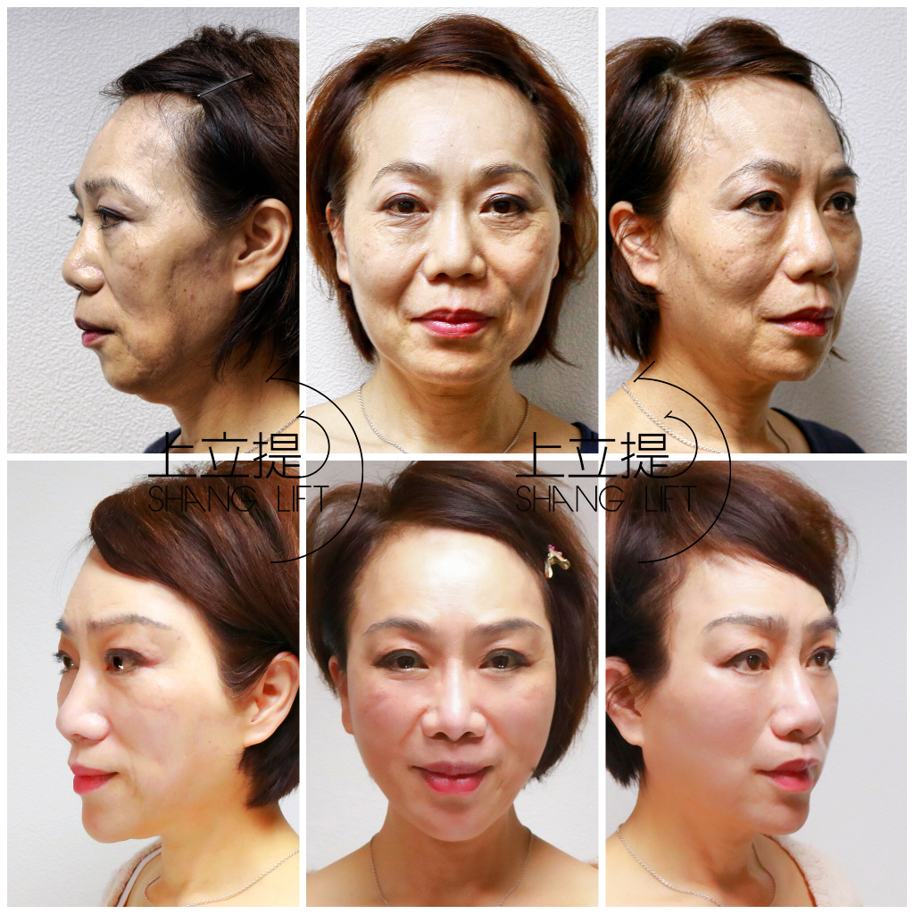 新Ellansé 洢蓮絲少女針PolycaprolactonePCL膠原增生劑洢蓮絲上立皮膚科林上立洢蓮絲拉提上立皮膚科 費用 林上立 價格 林上立 評價 液態拉皮上立提 液態拉皮 推薦液態拉皮Ellanse洢蓮絲易麗適依戀詩聚己內酯少女計劃3D聚左旋乳酸 舒顏萃 童顏針Sculptra02.jpg 新Ellansé 洢蓮絲少女針PolycaprolactonePCL膠原增生劑洢蓮絲上立皮膚科林上立洢蓮絲拉提上立皮膚科 費用 林上立 價格 林上立 評價 液態拉皮上立提 液態拉皮 推薦液態拉皮Ellanse洢蓮絲易麗適依戀詩聚己內酯少女計劃3D聚左旋乳酸 舒顏萃 童顏針Sculptra02.jpg