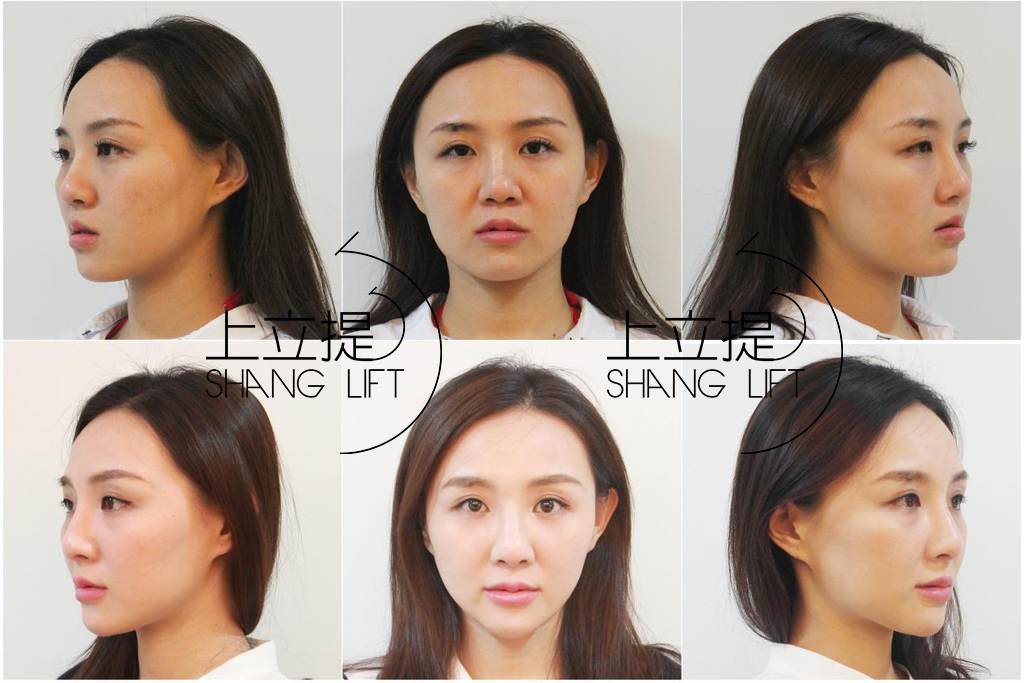 新Ellansé 洢蓮絲少女針PolycaprolactonePCL膠原增生劑洢蓮絲上立皮膚科林上立洢蓮絲拉提上立皮膚科 費用 林上立 價格 林上立 評價 液態拉皮上立提 液態拉皮 推薦液態拉皮Ellanse洢蓮絲易麗適依戀詩聚己內酯少女計劃3D聚左旋乳酸 舒顏萃 童顏針Sculptra03.jpg 新Ellansé 洢蓮絲少女針PolycaprolactonePCL膠原增生劑洢蓮絲上立皮膚科林上立洢蓮絲拉提上立皮膚科 費用 林上立 價格 林上立 評價 液態拉皮上立提 液態拉皮 推薦液態拉皮Ellanse洢蓮絲易麗適依戀詩聚己內酯少女計劃3D聚左旋乳酸 舒顏萃 童顏針Sculptra03.jpg