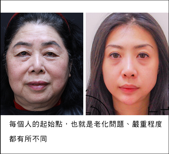 液態拉皮上立提3D聚左旋乳酸童顏針塑然雅Sculptra舒顏萃洢蓮絲ellanse依戀詩少女針3 液態拉皮上立提3D聚左旋乳酸童顏針塑然雅Sculptra舒顏萃洢蓮絲ellanse依戀詩少女針3