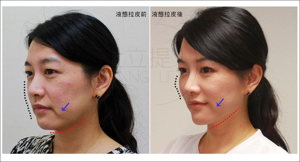液態拉皮上立提3D聚左旋乳酸童顏針塑然雅Sculptra舒顏萃洢蓮絲ellanse依戀詩少女針4 液態拉皮上立提3D聚左旋乳酸童顏針塑然雅Sculptra舒顏萃洢蓮絲ellanse依戀詩少女針4