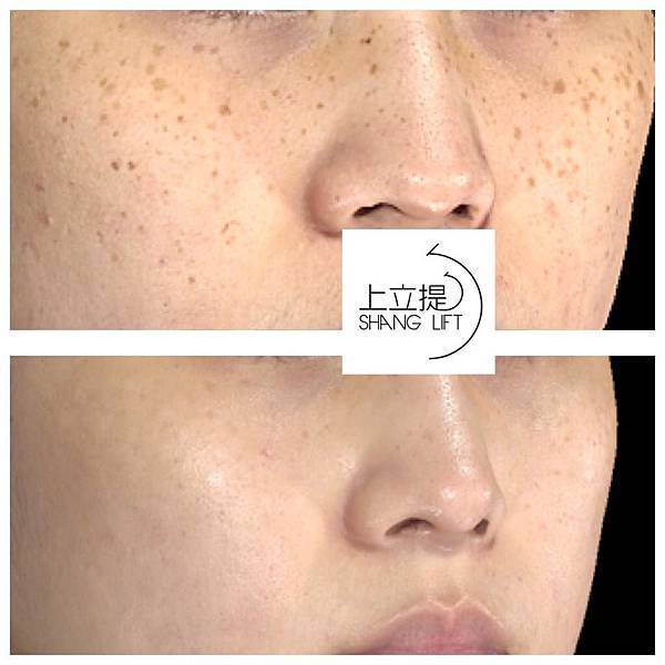 PicoSure755蜂巢皮秒雷射蜂巢透鏡淨膚雷射飛梭雷射1.jpg PicoSure755蜂巢皮秒雷射蜂巢透鏡淨膚雷射飛梭雷射1.jpg