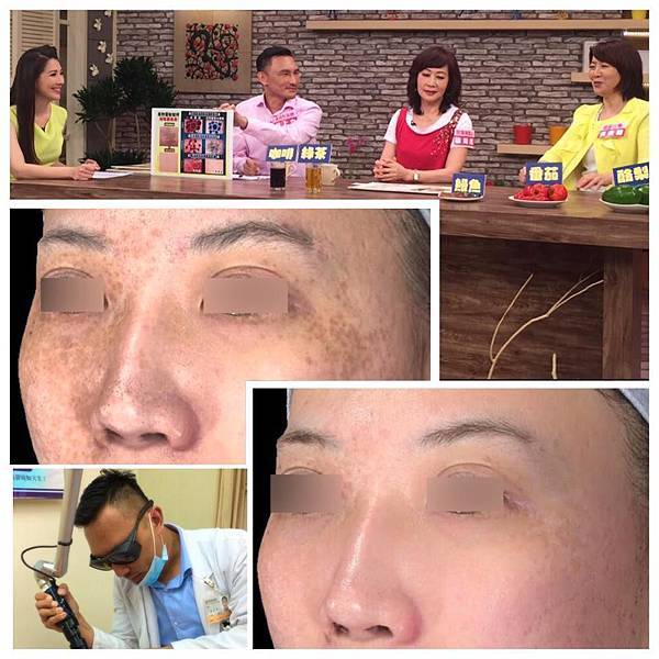 PicoSure755蜂巢皮秒雷射蜂巢透鏡淨膚雷射飛梭雷射2.jpg PicoSure755蜂巢皮秒雷射蜂巢透鏡淨膚雷射飛梭雷射2.jpg