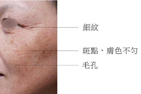 PicoSure755蜂巢皮秒雷射蜂巢透鏡淨膚雷射飛梭雷射3.jpg PicoSure755蜂巢皮秒雷射蜂巢透鏡淨膚雷射飛梭雷射3.jpg