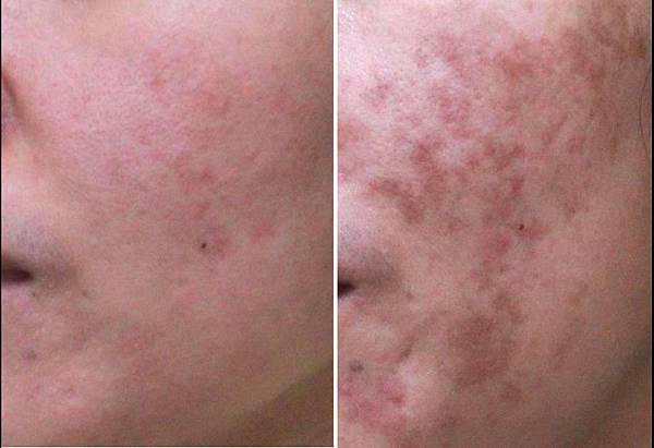 PicoSure755蜂巢皮秒雷射蜂巢透鏡淨膚雷射飛梭雷射4.jpg PicoSure755蜂巢皮秒雷射蜂巢透鏡淨膚雷射飛梭雷射4.jpg