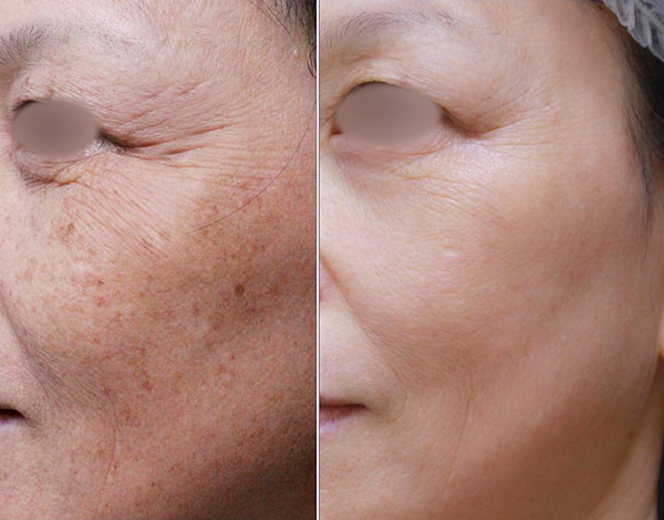 PicoSure755蜂巢皮秒雷射蜂巢透鏡淨膚雷射飛梭雷射6.png PicoSure755蜂巢皮秒雷射蜂巢透鏡淨膚雷射飛梭雷射6.png