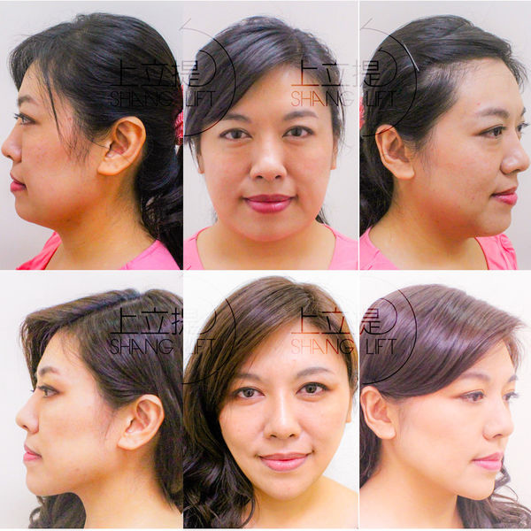 PicoSure755皮秒雷射蜂巢透鏡 皮秒雷射 二代皮秒上立皮膚科 費用 林上立 價格 林上立 評價 液態拉皮上立提 液態拉皮 推薦 少女計劃08 PicoSure755皮秒雷射蜂巢透鏡 皮秒雷射 二代皮秒上立皮膚科 費用 林上立 價格 林上立 評價 液態拉皮上立提 液態拉皮 推薦 少女計劃08