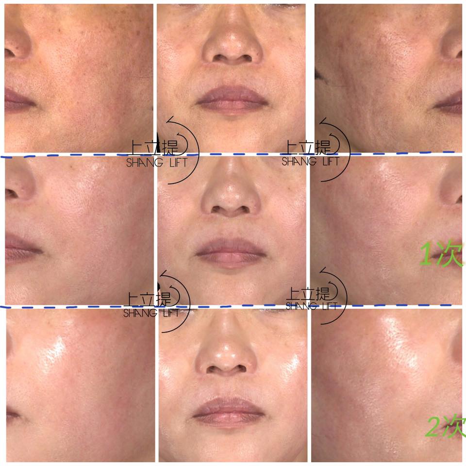 PicoSure755皮秒雷射蜂巢透鏡 皮秒雷射 二代皮秒上立皮膚科 費用 林上立 價格 林上立 評價 液態拉皮上立提 液態拉皮 推薦 少女計劃09 PicoSure755皮秒雷射蜂巢透鏡 皮秒雷射 二代皮秒上立皮膚科 費用 林上立 價格 林上立 評價 液態拉皮上立提 液態拉皮 推薦 少女計劃09