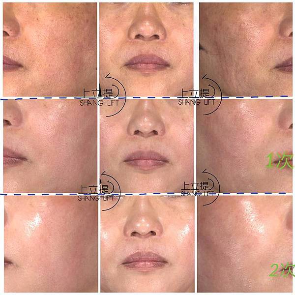 PicoSure755皮秒雷射蜂巢透鏡 皮秒雷射 二代皮秒上立皮膚科 費用 林上立 價格 林上立 評價 液態拉皮上立提 液態拉皮 推薦 少女計劃09 PicoSure755皮秒雷射蜂巢透鏡 皮秒雷射 二代皮秒上立皮膚科 費用 林上立 價格 林上立 評價 液態拉皮上立提 液態拉皮 推薦 少女計劃09