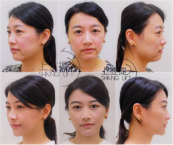 PicoSure755皮秒雷射蜂巢透鏡 皮秒雷射 二代皮秒上立皮膚科 費用 林上立 價格 林上立 評價 液態拉皮上立提 液態拉皮 推薦 少女計劃10 PicoSure755皮秒雷射蜂巢透鏡 皮秒雷射 二代皮秒上立皮膚科 費用 林上立 價格 林上立 評價 液態拉皮上立提 液態拉皮 推薦 少女計劃10